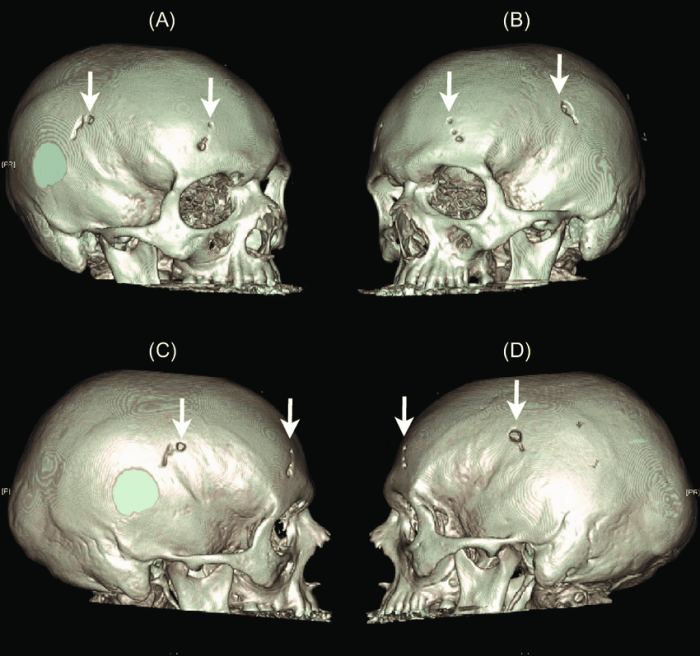 The application of a cranial halo is a form of